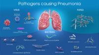 Pneumonia Merebak, Tangerang Paling Parah di Banten